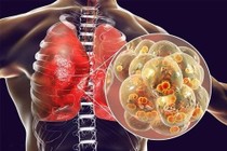 Mách bạn cách phòng bệnh viêm phổi tái phát hiệu quả
