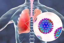 Bệnh viêm phổi có nguy hiểm không? Điều trị bao lâu thì khỏi?