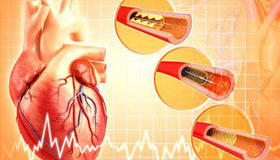Mức hưởng bảo hiểm y tế khi đặt stent tim