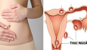 Đau bụng ở phụ nữ... có thể dấu hiệu chửa ngoài tử cung