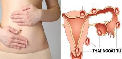 Đau bụng ở phụ nữ... có thể dấu hiệu chửa ngoài tử cung