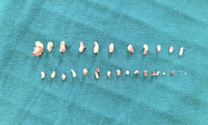 Hơn 28 chiếc răng dị dạng trong khối u của bé trai 9 tuổi ảnh 1