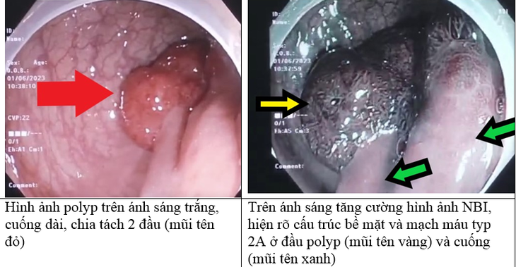 Hy hữu: Polyp đại trực tràng cũng có đôi | Khoa học và Đời sống