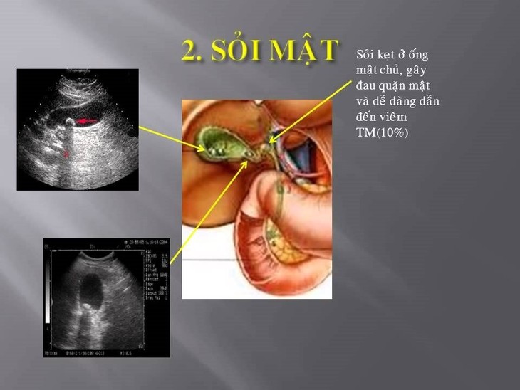 Phát hiện sớm sỏi túi mật tránh các biến chứng nguy hiểm tính mạng ảnh 1 soi-tui-mat-1.jpg