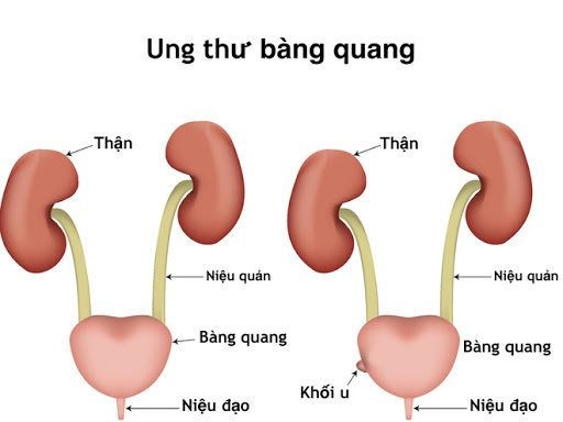 U bàng quang, tinh hoàn ở trẻ ảnh 1 u-bang-quang-tinh-hoa.jpg