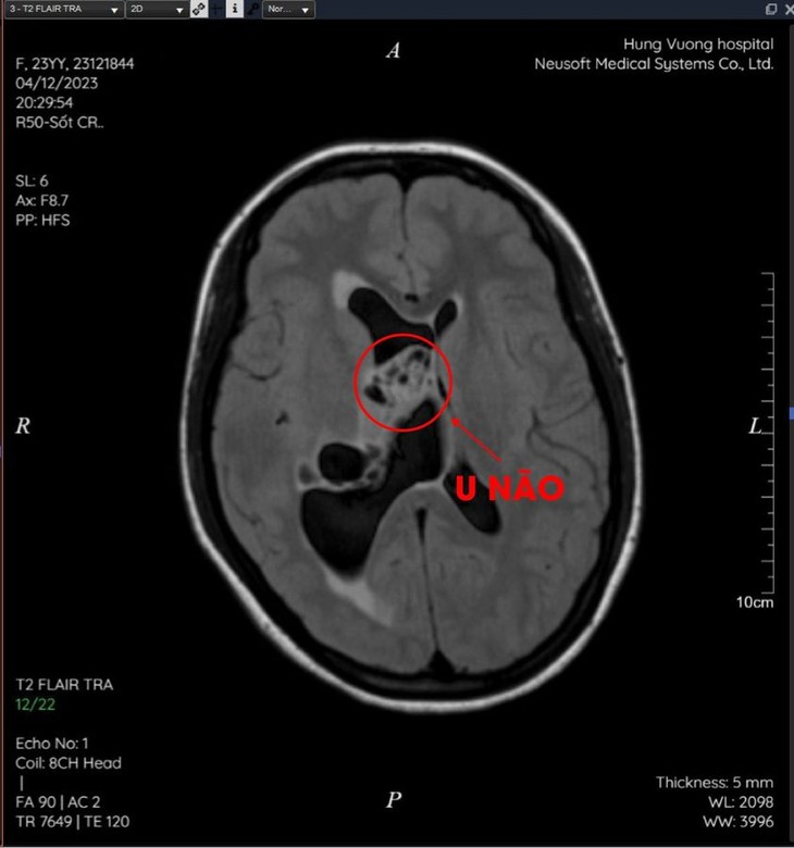 Đau âm ỉ vùng trán, cô gái 23 tuổi phát hiện khối u não nguy hiểm ảnh 2