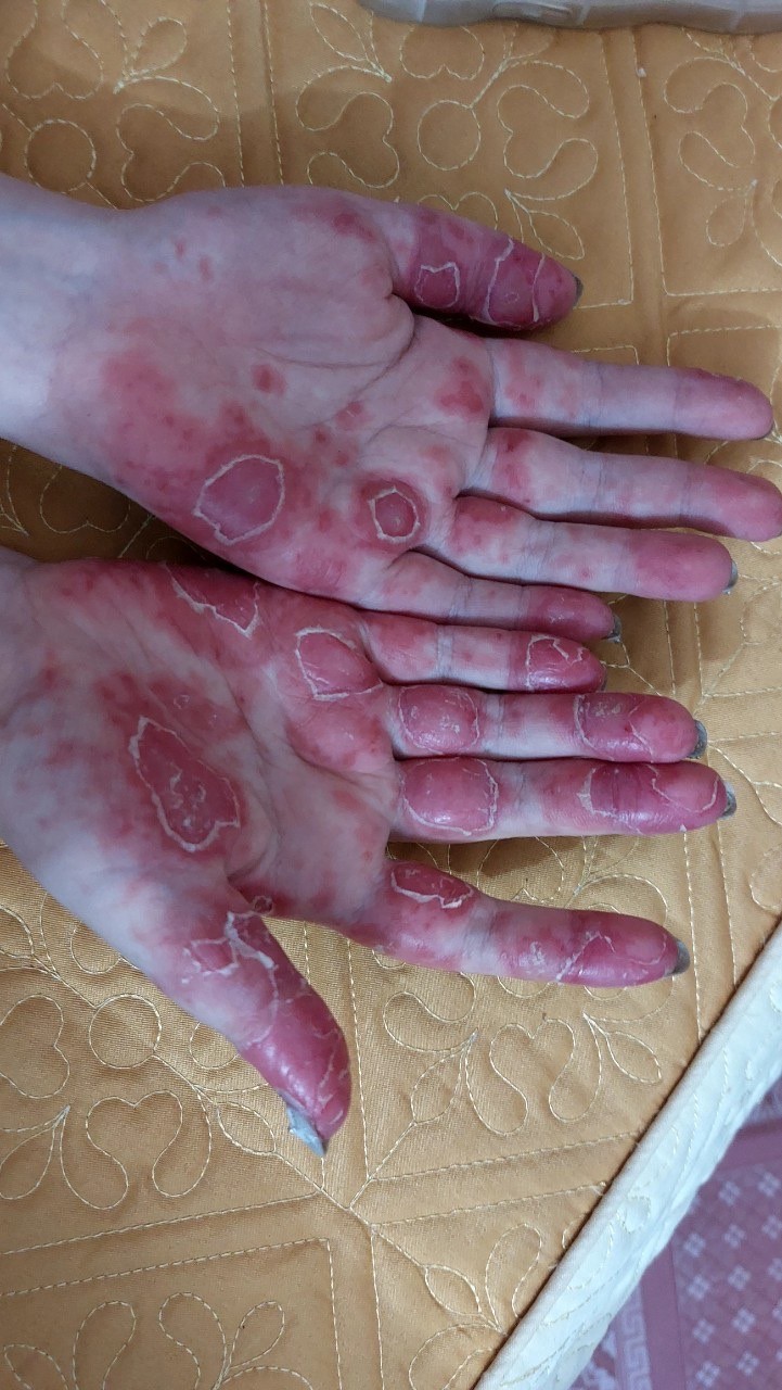 Biểu hiện trên tay của bệnh nhân lupus ban đỏ
