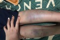  Đà Nẵng: Diễn biến mới vụ học sinh lớp 1 bị đánh bầm tím 