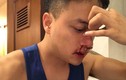 Cao Thái Sơn chảy máu mũi nhập viện khẩn cấp lúc nửa đêm