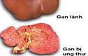 Mách bạn cách ngăn ngừa ung thư gan hữu hiệu