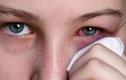 Những yếu tố hàng đầu gây ung thư mắt