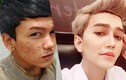 Khuôn mặt mụn khủng khiếp của hot boy Malaysia trước khi "dao kéo"