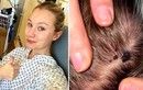 Cô gái 29 tuổi phát hiện ung thư từ vết lạ trên đầu