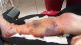 Đăk Lắk: Thiếu nữ phải cưa chân vì bác sĩ tắc trách