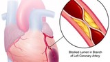 Mối liên hệ giữa bệnh mỡ máu cao và bệnh tim mạch 