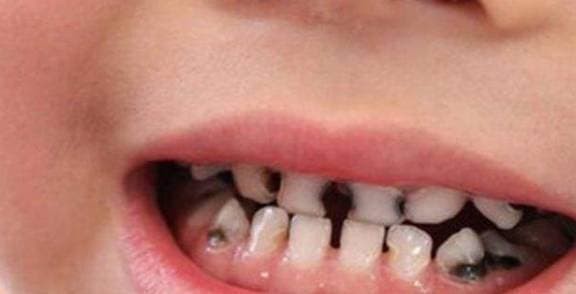 Nhấn vào ảnh để phóng to Loat thoi quen khien tre bi sau rang, cha me nen chu y som